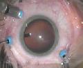 Auge während einer Operation